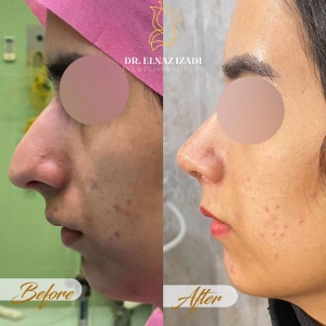 1_rhinoplasty-2