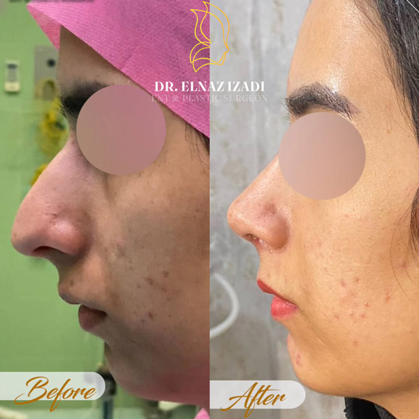 عکس نمونه کار جراحی بینی در لرستان