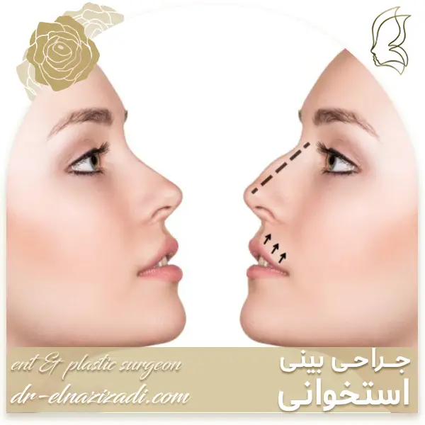 عمل بینی استخوانی