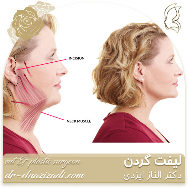 لیفت گردن