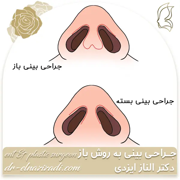 جراحی بینی به روش باز