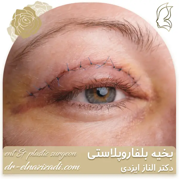 بخیه بلفاروپلاستی