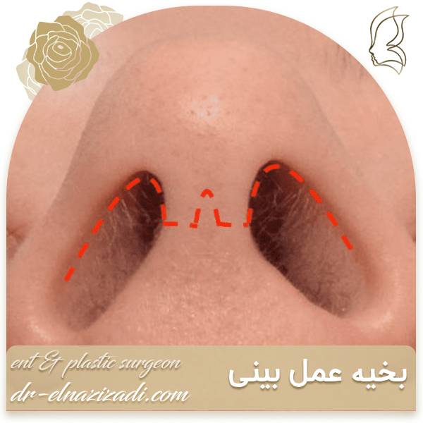 بخیه عمل بینی