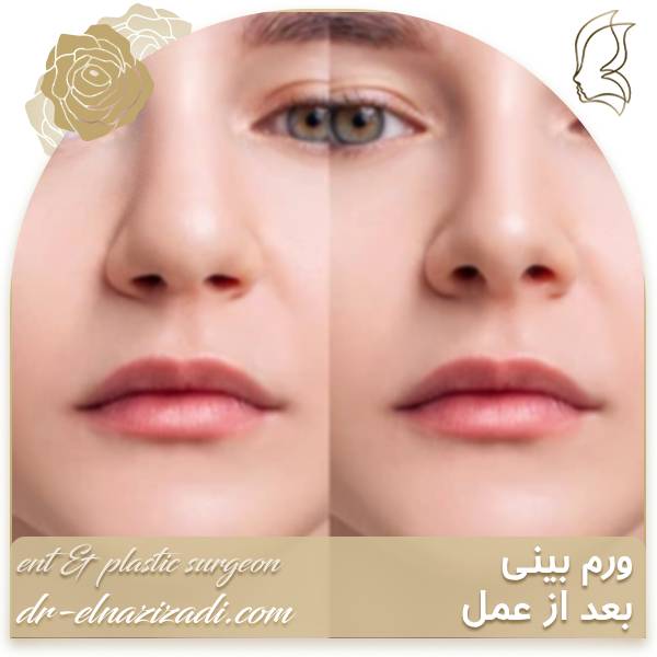 ورم بینی بعد از عمل
