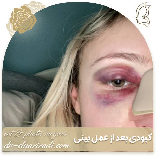 کبودی عمل بینی | دکتر ایزدی