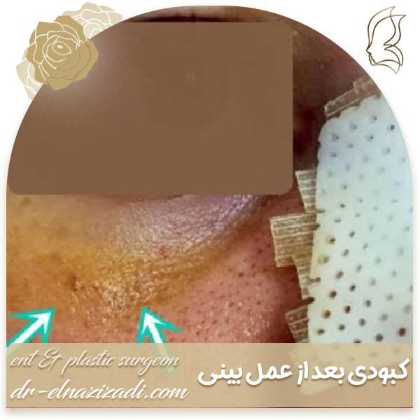 کبودی عمل بینی | دکتر ایزدی