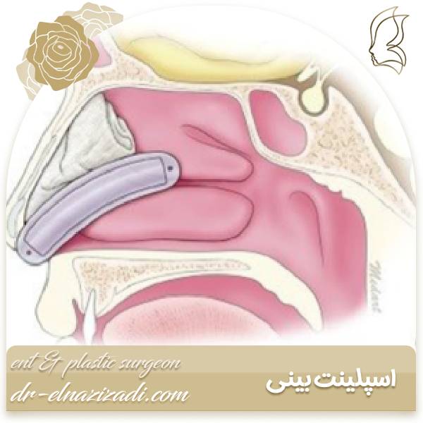 اسپلینت بینی